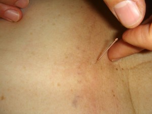 acupuncture-289251_1280-1-300×225