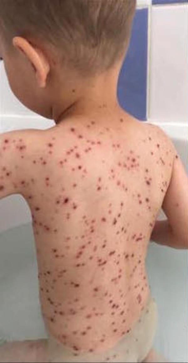 chickenpox-01