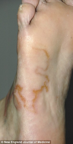 worm-removed