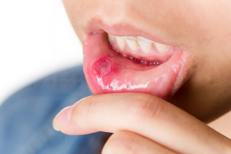 canker-sore-e1464185627790