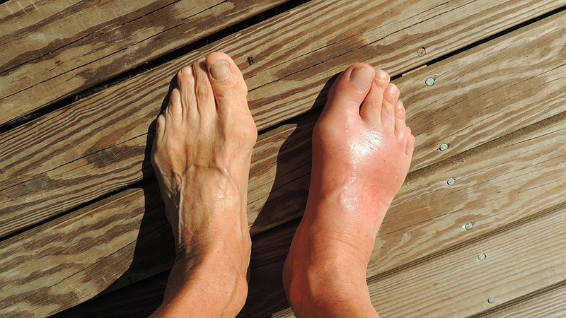 uric-acid_feet-174216_cnick_pixabay_gout